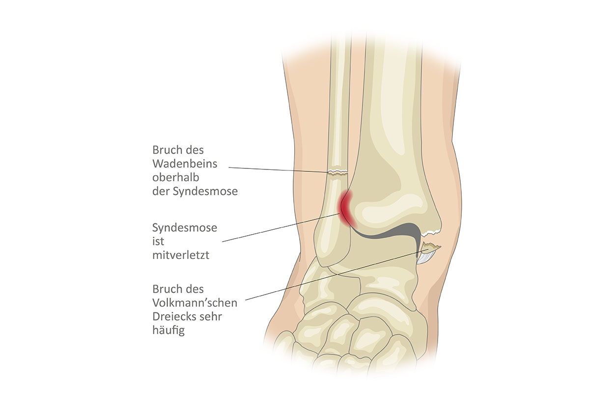 Anatomiegrafik Sprunggelenk, Weber Fraktur C beschriftet, Website