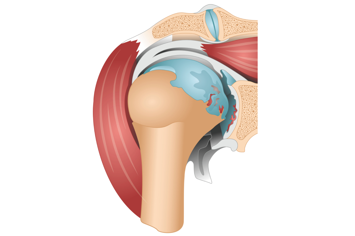 illustratordatei Anatomische Zeichnung Arthrose Schultergelenk