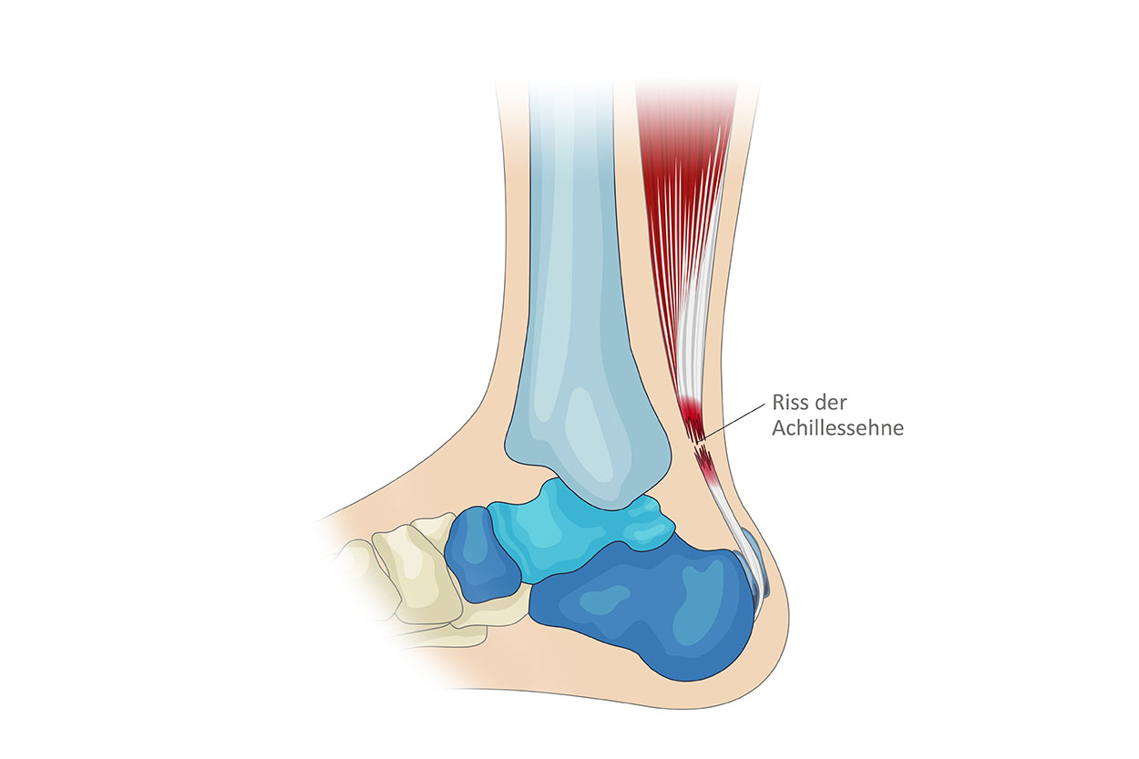 Anatomiegrafik Sprunggelenk, Riss der Achillessehne beschriftet, Website