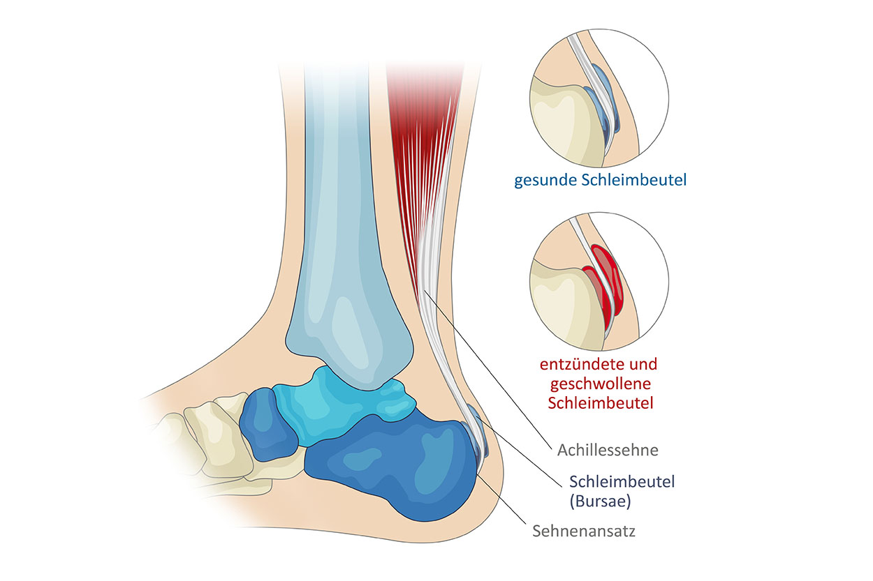 Anatomiegrafik Sprunggelenk, Schleimbeutel (Bursae) beschriftet, Website