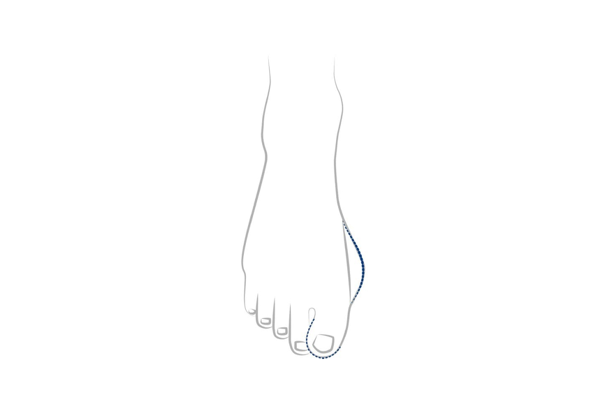 Zeichnung Fuss Hallux Valgus